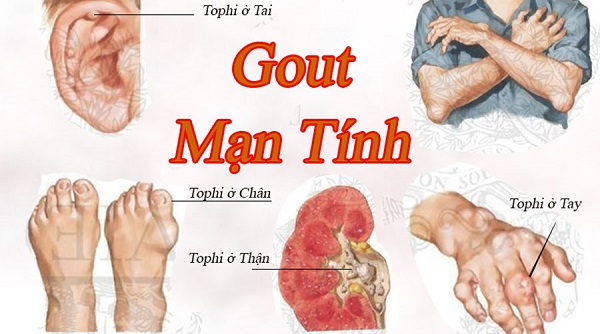 Cây xạ đen có hỗ trợ điều trị bệnh Gout (Gút) không ?